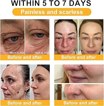 Bee Venam Wart & Mole Removel Cream